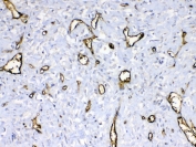 IHC testing of FFPE human breast cancer tissue with HBD antibody at 1ug/ml. Required HIER: steam section in pH6 citrate buffer for 20 min and allow to cool prior to testing.