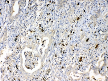 IHC testing of FFPE human intestinal cancer tissue with HBD antibody at 1ug/ml. Required HIER: steam section in pH6 citrate buffer for 20 min and allow to cool prior to testing.