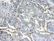 IHC testing of FFPE human lung cancer tissue with HBD antibody at 1ug/ml. Required HIER: steam section in pH6 citrate buffer for 20 min and allow to cool prior to testing.