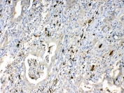IHC testing of FFPE human intestinal cancer tissue with HBD antibody at 1ug/ml. Required HIER: steam section in pH6 citrate buffer for 20 min and allow to cool prior to testing.