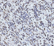 IHC staining of FFPE human gastric adenocarcinoma tissue with PDCD4 antibody. HIER: boil tissue sections in pH8 EDTA for 20 min and allow to cool before testing.