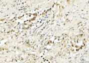 IHC staining of FFPE human appendiceal adenocarcinoma tissue with PDCD4 antibody. HIER: boil tissue sections in pH8 EDTA for 20 min and allow to cool before testing.
