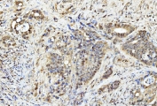 IHC staining of FFPE human gall bladder adenosquamous carcinoma tissue with PDCD4 antibody. HIER: boil tissue sections in pH8 EDTA for 20 min and allow to cool before testing.