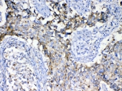 IHC testing of FFPE human lung cancer tissue with SCF antibody at 1ug/ml. Required HIER: steam section in pH6 citrate buffer for 20 min and allow to cool prior to testing.