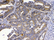 IHC testing of FFPE human colon cancer tissue with SCF antibody at 1ug/ml. Required HIER: steam section in pH6 citrate buffer for 20 min and allow to cool prior to testing.