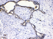 IHC testing of FFPE human breast cancer tissue with SCF antibody at 1ug/ml. Required HIER: steam section in pH6 citrate buffer for 20 min and allow to cool prior to testing.