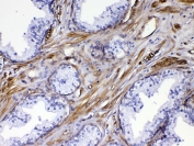 IHC testing of FFPE human prostate cancer tissue with VEGFR3 antibody at 1ug/ml. Required HIER: steam section in pH6 citrate buffer for 20 min and allow to cool prior to testing.