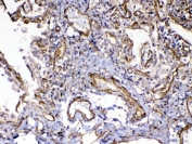 IHC testing of FFPE human lung cancer tissue with VEGFR3 antibody at 1ug/ml. Required HIER: steam section in pH6 citrate buffer for 20 min and allow to cool prior to testing.