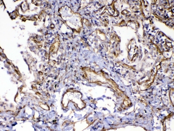 IHC testing of FFPE human lung cancer tissue with VEGFR3 antibody at 1ug/ml. Required HIER: steam section in pH6 citrate buffer for 20 min and allow to cool prior to testing.