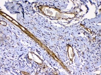 IHC testing of FFPE human breast cancer tissue with VEGFR3 antibody at 1ug/ml. Required HIER: steam section in pH6 citrate buffer for 20 min and allow to cool prior to testing.