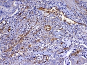 IHC testing of FFPE human colon cancer tissue with VEGFR3 antibody at 1ug/ml. Required HIER: steam section in pH6 citrate buffer for 20 min and allow to cool prior to testing.