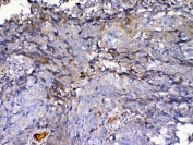 IHC testing of FFPE human lung cancer tissue with IGFBP2 antibody at 1ug/ml. Required HIER: steam section in pH6 citrate buffer for 20 min and allow to cool prior to testing.