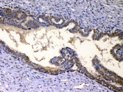 IHC testing of FFPE human breast cancer tissue with IGFBP2 antibody at 1ug/ml. Required HIER: steam section in pH6 citrate buffer for 20 min and allow to cool prior to testing.