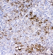 IHC staining of FFPE human liver cancer with GSTA antibody. HIER: boil tissue sections in pH6, 10mM citrate buffer, for 10-20 min followed by cooling at RT for 20 min.