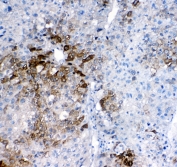 IHC staining of FFPE human liver cancer with GSTA antibody. HIER: boil tissue sections in pH6, 10mM citrate buffer, for 10-20 min followed by cooling at RT for 20 min.