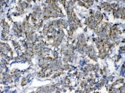 IHC testing of FFPE human lung cancer tissue with FH antibody at 1ug/ml. Required HIER: steam section in pH6 citrate buffer for 20 min and allow to cool prior to testing.