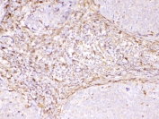 IHC testing of FFPE human lung cancer tissue with Cyclophilin B antibody at 1ug/ml. Required HIER: steam section in pH6 citrate buffer for 20 min and allow to cool prior to testing.