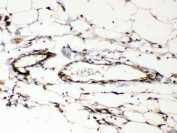 IHC testing of FFPE human breast cancer tissue with Cyclophilin B antibody at 1ug/ml. Required HIER: steam section in pH6 citrate buffer for 20 min and allow to cool prior to testing.