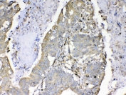 IHC testing of FFPE human rectal cancer tissue with Cyclophilin B antibody at 1ug/ml. Required HIER: steam section in pH6 citrate buffer for 20 min and allow to cool prior to testing.