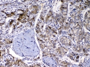 IHC testing of FFPE human liver cancer tissue with VDBP antibody at 1ug/ml. Required HIER: steam section in pH6 citrate buffer for 20 min and allow to cool prior to testing.