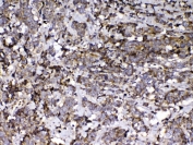 IHC testing of FFPE human lung cancer tissue with VDBP antibody at 1ug/ml. Required HIER: steam section in pH6 citrate buffer for 20 min and allow to cool prior to testing.