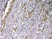 IHC testing of FFPE human rectal cancer tissue with VDBP antibody at 1ug/ml. Required HIER: steam section in pH6 citrate buffer for 20 min and allow to cool prior to testing.