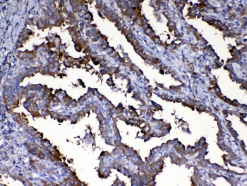 IHC testing of FFPE human lung cancer tissue with Calpain 2 antibody at 1ug/ml. Required HIER: steam section in pH6 citrate buffer for 20 min and allow to cool prior to testing.
