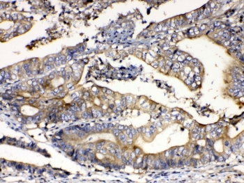 IHC testing of FFPE human intestinal cancer tissue with Calpain 2 antibody at 1ug/ml. Required HIER: steam section in pH6 citrate buffer for 20 min and allow to cool prior to testing.