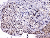 IHC testing of FFPE human lung cancer tissue with MED15 antibody at 1ug/ml. Required HIER: steam section in pH6 citrate buffer for 20 min and allow to cool prior to testing.