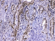 IHC testing of FFPE human colon cancer tissue with MED15 antibody at 1ug/ml. Required HIER: steam section in pH6 citrate buffer for 20 min and allow to cool prior to testing.