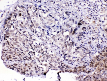 IHC testing of FFPE human lung cancer tissue with MED15 antibody at 1ug/ml. Required HIER: steam section in pH6 citrate buffer for 20 min and allow to cool prior to testing.