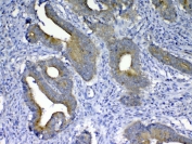 IHC testing of FFPE human colon cancer tissue with MMP10 antibody at 1ug/ml. Required HIER: steam section in pH6 citrate buffer for 20 min and allow to cool prior to testing.