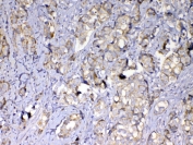 IHC testing of FFPE human breast cancer tissue with MMP10 antibody at 1ug/ml. Required HIER: steam section in pH6 citrate buffer for 20 min and allow to cool prior to testing.
