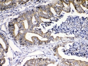 IHC testing of FFPE human colon cancer tissue with TNFSF18 antibody at 1ug/ml. Required HIER: steam section in pH6 citrate buffer for 20 min and allow to cool prior to testing.