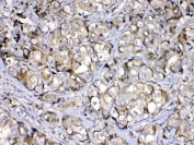 IHC testing of FFPE human breast cancer tissue with COPE antibody at 1ug/ml. Required HIER: steam section in pH6 citrate buffer for 20 min and allow to cool prior to testing.