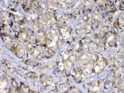 IHC testing of FFPE human breast cancer tissue with COPE antibody at 1ug/ml. Required HIER: steam section in pH6 citrate buffer for 20 min and allow to cool prior to testing.