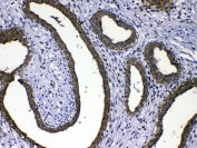 IHC testing of FFPE human breast cancer tissue with MMP16 antibody at 1ug/ml. Required HIER: steam section in pH6 citrate buffer for 20 min and allow to cool prior to testing.
