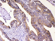 IHC testing of FFPE human intestinal cancer tissue with AMD1 antibody at 1ug/ml. Required HIER: steam section in pH6 citrate buffer for 20 min and allow to cool prior to testing.