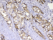 IHC testing of FFPE human breast cancer tissue with AMD1 antibody at 1ug/ml. Required HIER: steam section in pH6 citrate buffer for 20 min and allow to cool prior to testing.