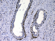 IHC testing of FFPE human breast cancer tissue with CCN3 antibody at 1ug/ml. Required HIER: steam section in pH6 citrate buffer for 20 min and allow to cool prior to testing.