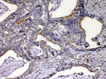 IHC testing of FFPE human intestinal cancer tissue with CCN3 antibody at 1ug/ml. Required HIER: steam section in pH6 citrate buffer for 20 min and allow to cool prior to testing.