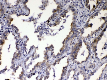 IHC testing of FFPE human lung cancer tissue with CCN3 antibody at 1ug/ml. Required HIER: steam section in pH6 citrate buffer for 20 min and allow to cool prior to testing.