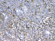 IHC testing of FFPE human glioma tissue with Neurocan antibody at 1ug/ml. Required HIER: steam section in pH6 citrate buffer for 20 min and allow to cool prior to testing.
