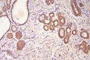 IHC staining of FFPE human breast cancer with HSP20 antibody. HIER: boil tissue sections in pH8 EDTA for 20 min and allow to cool before testing.
