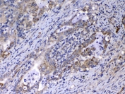 IHC testing of FFPE human colon cancer tissue with Relaxin antibody at 1ug/ml. Required HIER: steam section in pH6 citrate buffer for 20 min and allow to cool prior to testing.