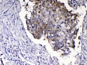 IHC testing of FFPE human lung cancer tissue with Relaxin antibody at 1ug/ml. Required HIER: steam section in pH6 citrate buffer for 20 min and allow to cool prior to testing.