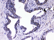 IHC testing of FFPE human prostate cancer tissue with Relaxin antibody at 1ug/ml. Required HIER: steam section in pH6 citrate buffer for 20 min and allow to cool prior to testing.