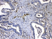 IHC testing of FFPE human intestinal cancer tissue with HOMER3 antibody at 1ug/ml. Required HIER: steam section in pH6 citrate buffer for 20 min and allow to cool prior to testing.