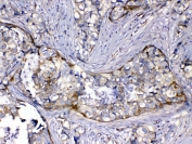 IHC testing of FFPE human breast cancer tissue with HOMER3 antibody at 1ug/ml. Required HIER: steam section in pH6 citrate buffer for 20 min and allow to cool prior to testing.