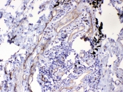 IHC testing of FFPE human lung cancer tissue with HOMER3 antibody at 1ug/ml. Required HIER: steam section in pH6 citrate buffer for 20 min and allow to cool prior to testing.